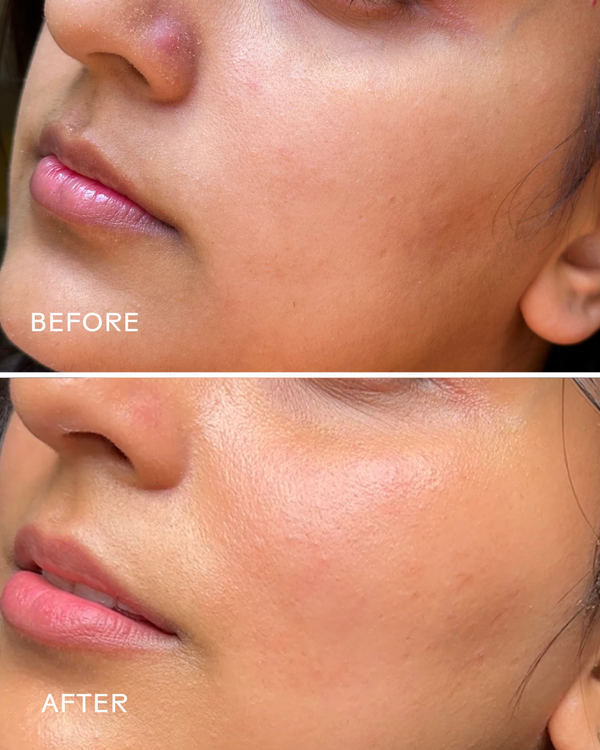 Close-up comparison of a person's cheek and lips before and after using Harmony Cucumber + Kombucha Microbiome Milky Balancing Cleanser | Three Ships, showing improved clear and smooth skin texture.