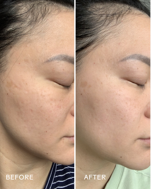 Side-by-side comparison of a woman's cheek before and after using Dew Drops Mushroom + Kakadu Plum Hyaluronic Acid Serum | Three Ships, showing improved skin clarity and reduced blemishes.