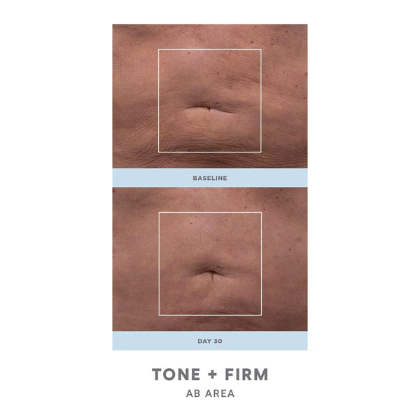 Comparison showing improved skin tone and firmness in the abdominal area after 30 days of using NuBODY® | NuFACE, demonstrating visible reduction in skin wrinkles and texture.