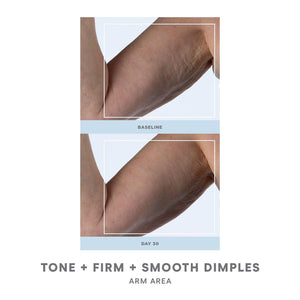 Comparison of a person's arm showing improved skin tone, firmness, and smoother dimples after 30 days using NuBODY® | NuFACE, highlighting body care and skincare results.