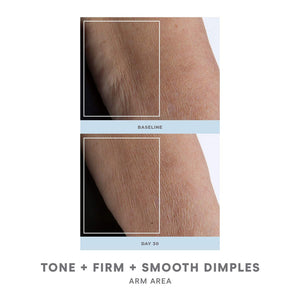 Side-by-side comparison of arm skin showing visible improvement in tone, firmness, and reduced dimples after 30 days of using NuBODY® | NuFACE wellness device.