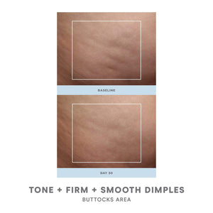Comparison of buttocks skin before and after 30 days showing improved tone, firmness, and smoother dimples using NuBODY® | NuFACE body care device.
