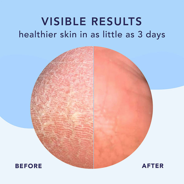 Comparison of dry, flaky skin before and smooth, hydrated skin after using High Dive Intensive Hydration Cream | Barefoot Scientist, showing visible improvement in 3 days.