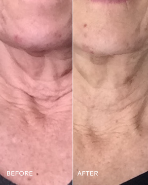 Before and after close-up comparison of a neck showing visibly smoother and firmer skin, demonstrating effects of Firm Believer Goji Stem Cell + Pomegranate Smoothing Neck + Face Cream | Three Ships in skincare.
