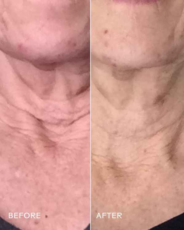 Before and after close-up comparison of a neck showing visibly smoother and firmer skin, demonstrating effects of Firm Believer Goji Stem Cell + Pomegranate Smoothing Neck + Face Cream | Three Ships in skincare.