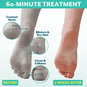 Comparison of feet showing cracked heels, blisters, dry skin, corns, and calluses before and smooth, healed skin two weeks after using PoshPeel™ Pedi Cure | Patchology 60-minute treatment for skincare and body care.