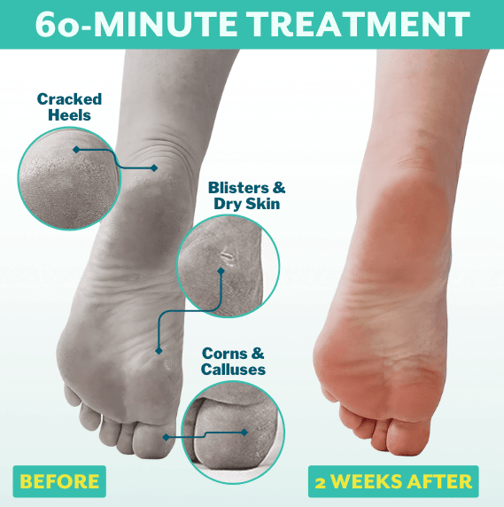 Comparison of feet showing cracked heels, blisters, dry skin, corns, and calluses before and smooth, healed skin two weeks after using PoshPeel™ Pedi Cure | Patchology 60-minute treatment for skincare and body care.