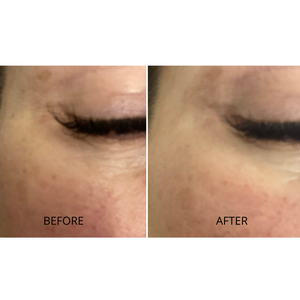 Close-up before and after comparison of under-eye area showing reduced wrinkles and smoother skin after using Hydrating Reusable Under Eye Patches | Dreambox Beauty skincare product.
