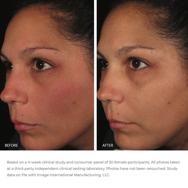 Before and after comparison of a woman’s face showing improved skin clarity and reduced redness after using ORMEDIC balancing antioxidant serum | IMAGE Skincare.