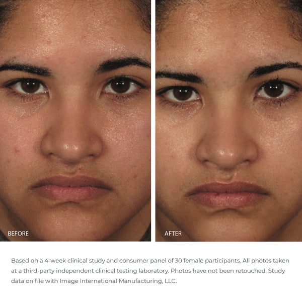 Before and after close-up comparison of a woman's face showing improved skin texture and clarity after using ORMEDIC balancing gel polisher | IMAGE Skincare, highlighting skincare results.