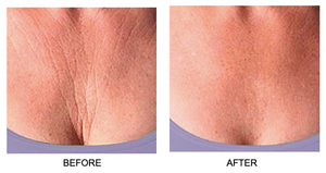 Comparison showing skin smoothing and plumping effects on chest area before and after using Skin Plumping Reusable Chest Pad | Dreambox Beauty for improved skincare results.