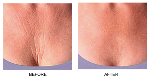 Comparison showing skin smoothing and plumping effects on chest area before and after using Skin Plumping Reusable Chest Pad | Dreambox Beauty for improved skincare results.