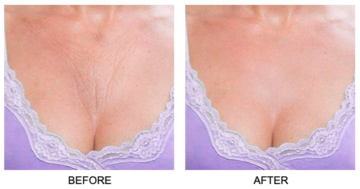 Before and after close-up of a woman's chest showing smoother, plumper skin achieved using the Skin Plumping Reusable Chest Pad | Dreambox Beauty, highlighting skincare and body care benefits.